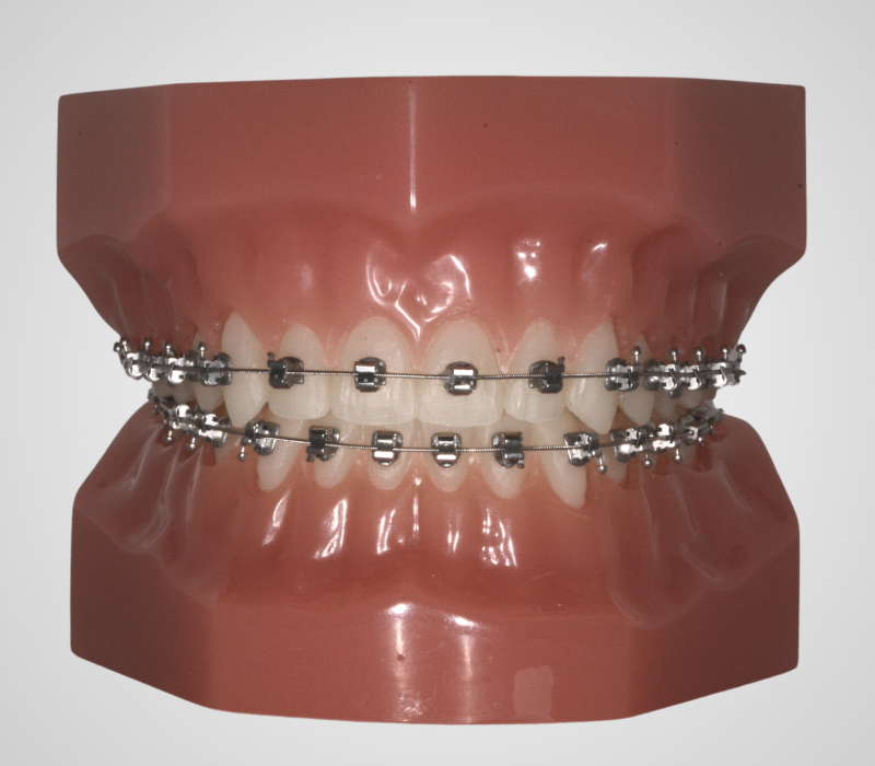Unterschied von Speed-Brackets zu normalen Brackets