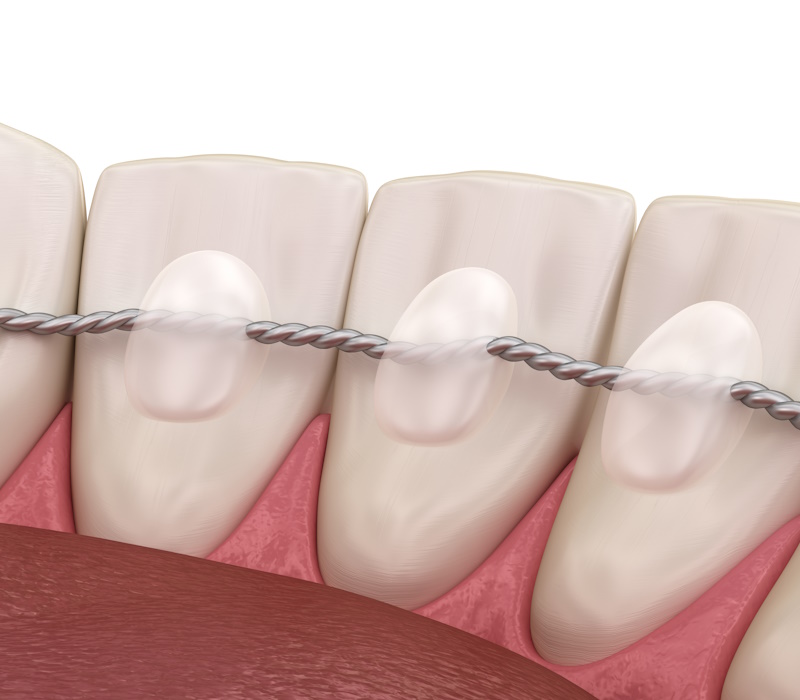 Retainers dental installed after braces treatment, Medically accurate dental 3D illustration