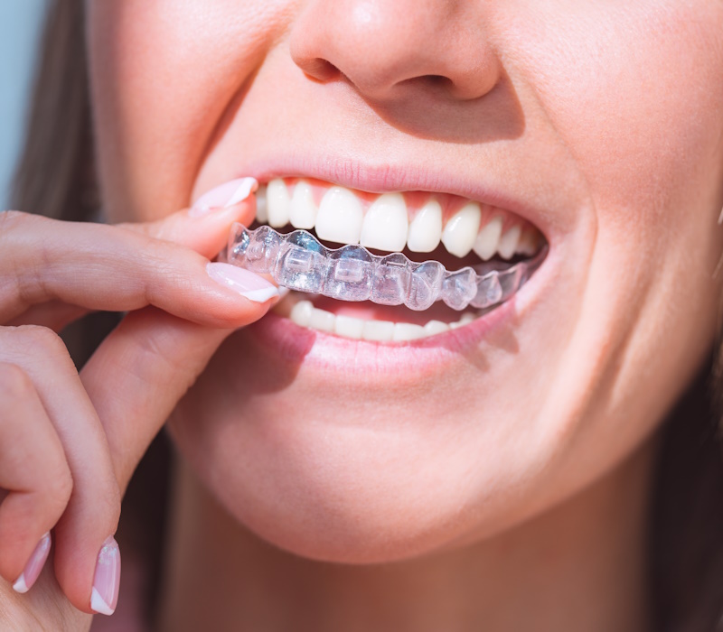 Woman with perfect smile wearing invisible dental aligners for dental correction. High quality photo