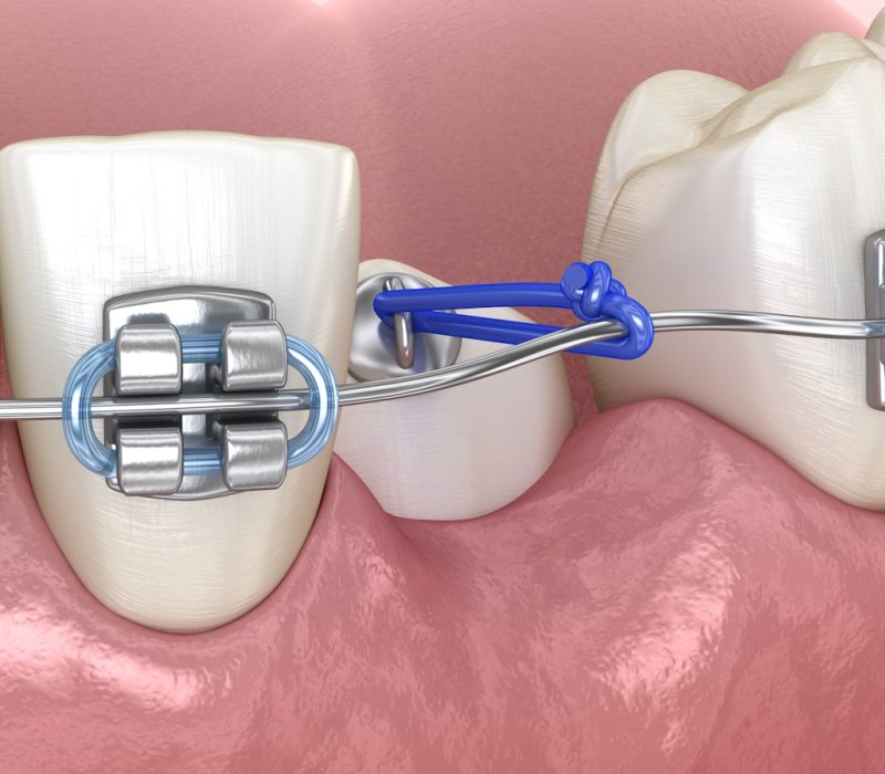 Impacted Cuspid and elastic for correction. Medically accurate dental 3D illustration