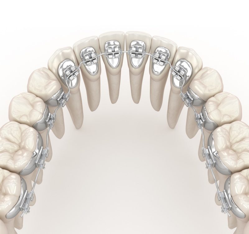 Lingual braces system. 3D illustration concept of silver braces